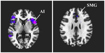 Investigation of functional connectivity differences based on anxiety tendencies